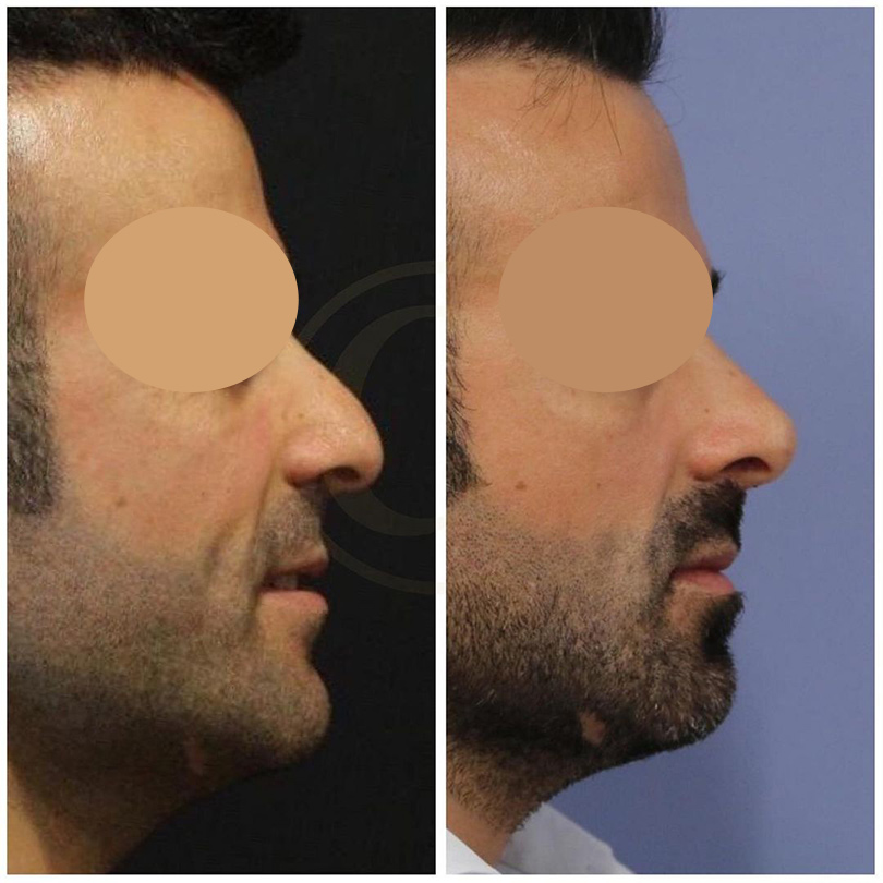 rhinoplasty surgery
