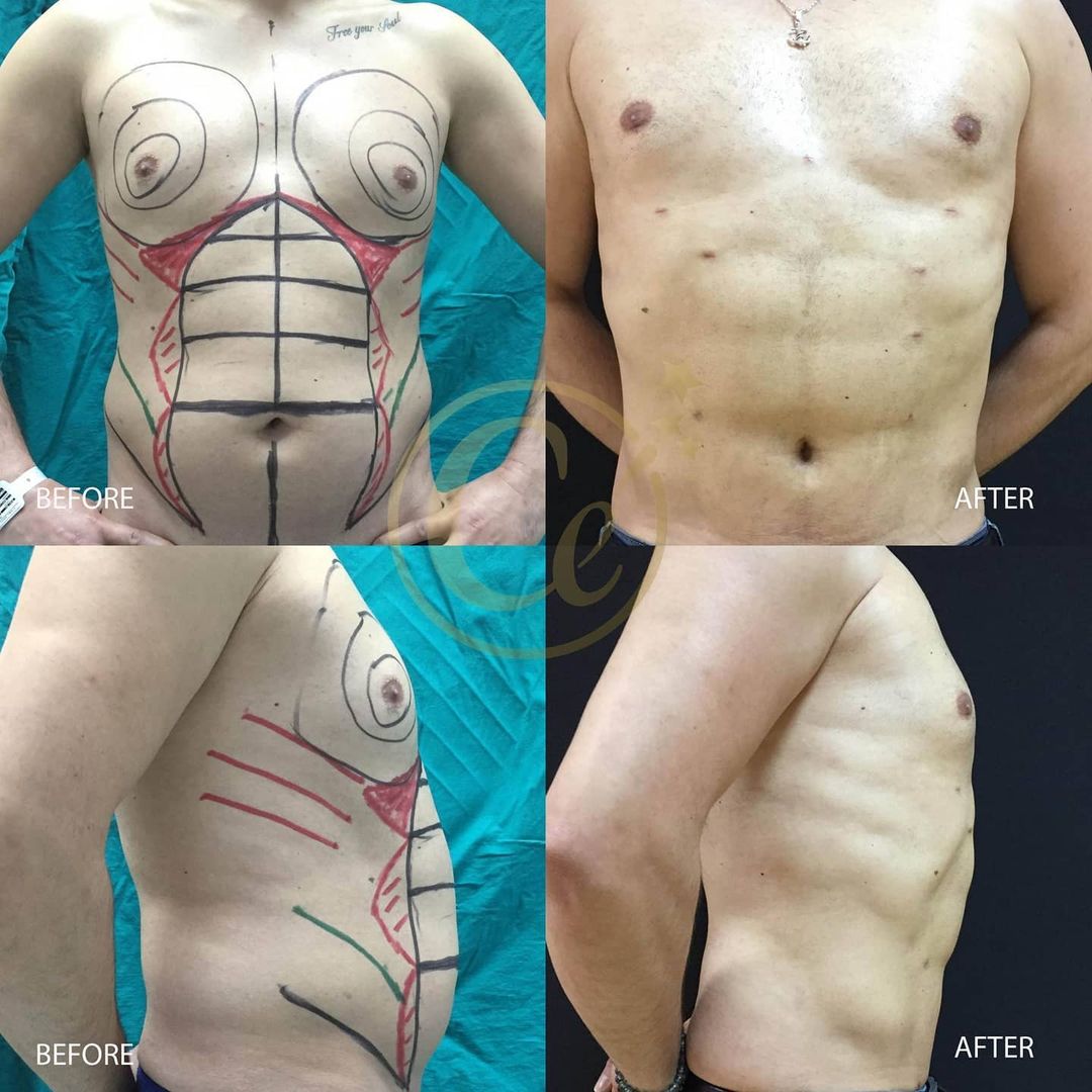 turkey tummy tuck before and after