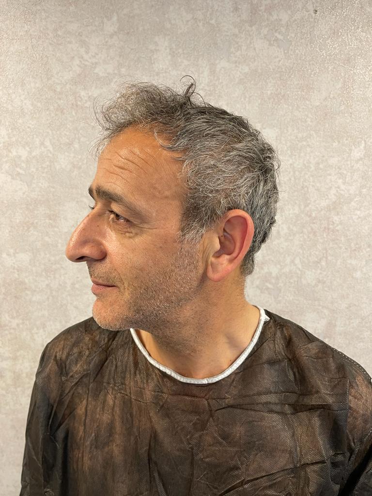 riza after turkey hair transplant surgery