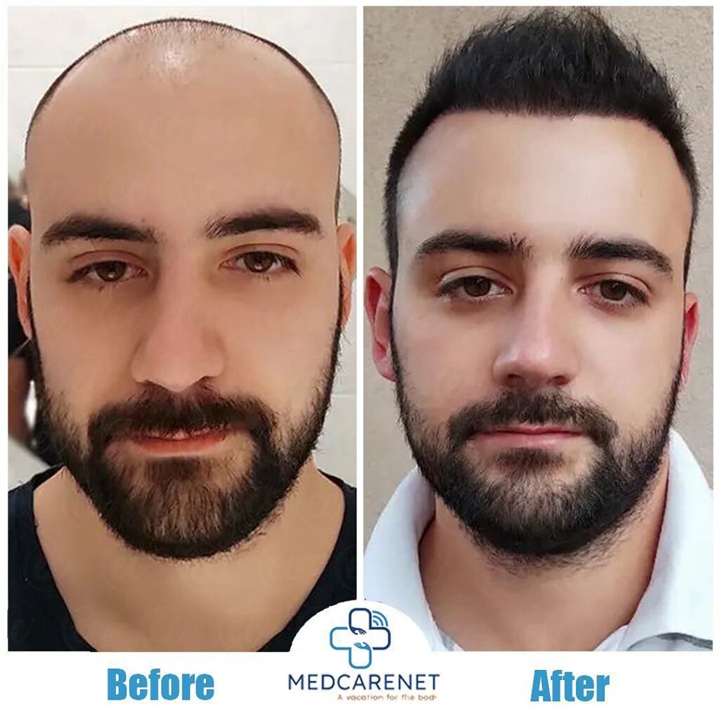 Turkey hair transplant before and after