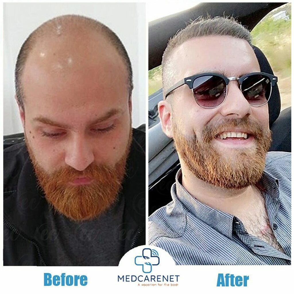 Turkey hair transplant before and after