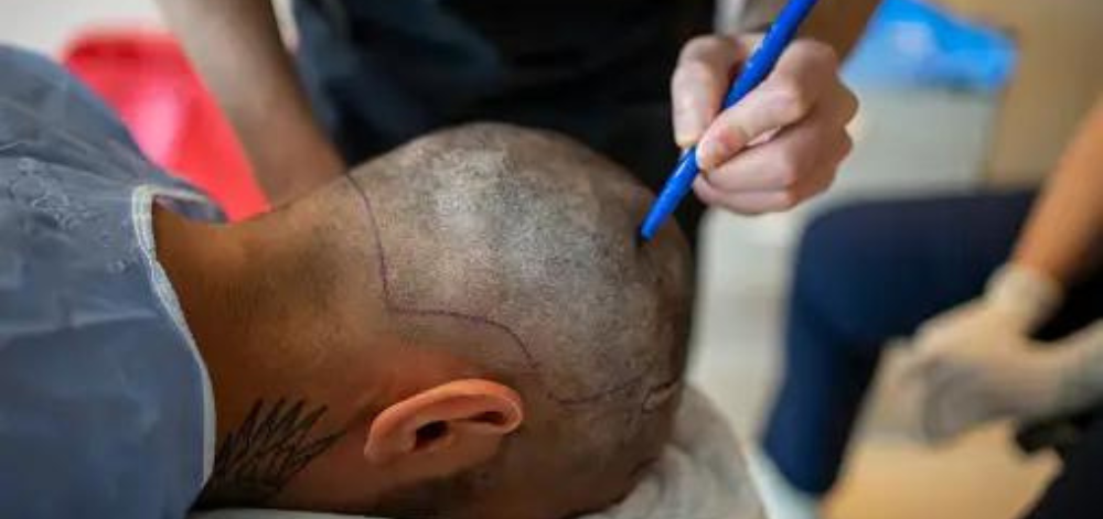 The Benefits of Combining Hair Surgery with a Trip to Turkey