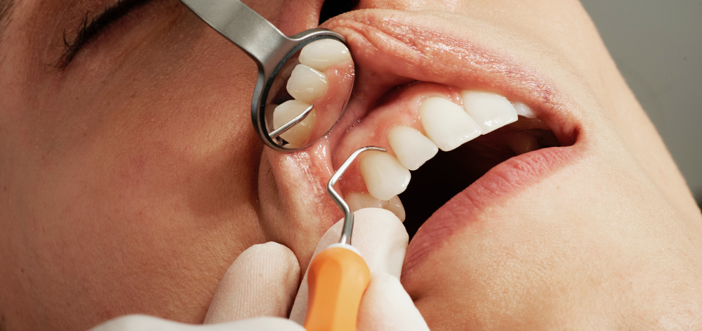 The Advantages of Turkey Dental Implants Over Traditional Solutions